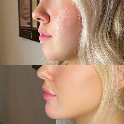 Expert Chin Fillers Treatments by the Best Plastic Surgeons in dubai