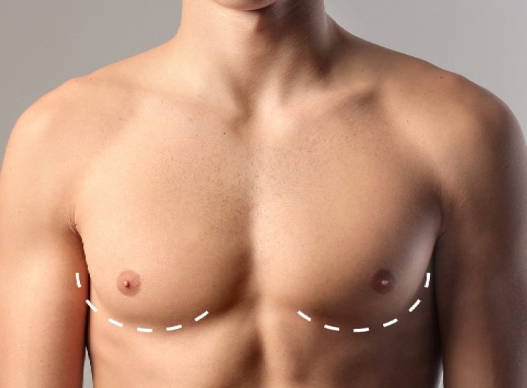 What to Expect Before, During, and After Gynecomastia in Dubai