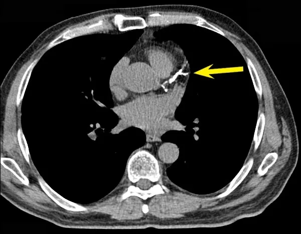 The Importance of Angiogram Imaging in Early Lung Cancer Detection