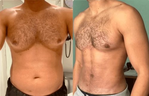 Gynecomastia in Dubai: When to Consider Surgery