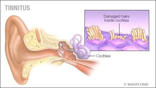 Tinnitus Treatment in Lahore & Pure Tone Audiometry Test Price