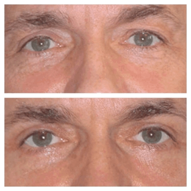 Finding Confidence with the Best Eye bag removal Surgeon in dubai