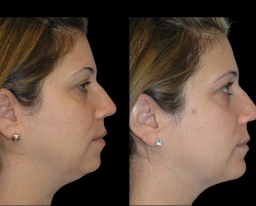 What the Best Double chin removal Surgeon in dubai Recommends for Aftercare