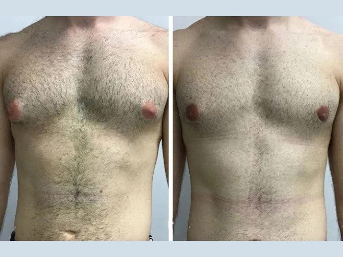 Best Gynecomastia Surgeons in Dubai: Get Natural-Looking Results with Experts