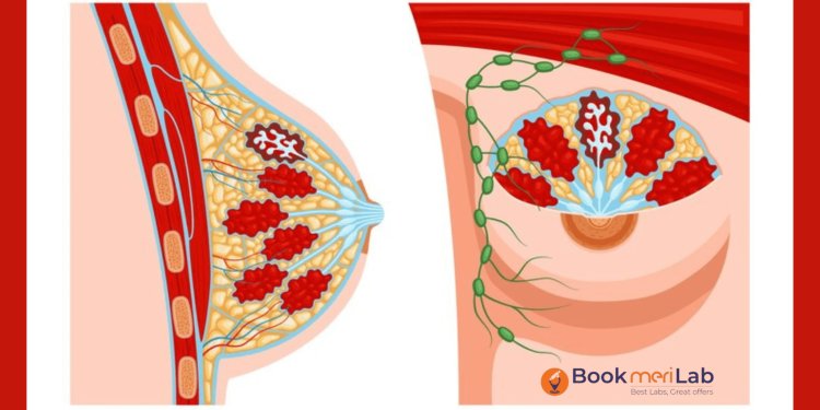 Kaise Pata Karein Ki Aapko Breast Cancer Hai? Symptoms Aur Diagnosis