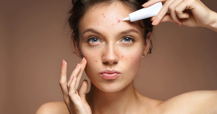 Isotretinoin for Acne: The Ultimate Solution for Clear Skin