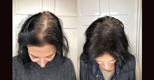 Scalp Micropigmentation vs. Hair Transplant: Which Is Better for Women?