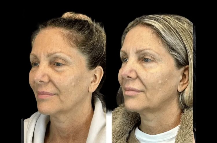 Botox for Wrinkles: The Best Plastic Surgeons in dubai Share Their Approaches