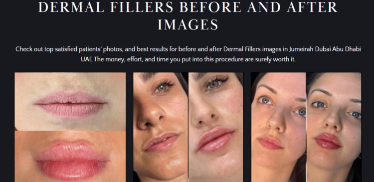 Dermal Fillers vs. Botox in Dubai: Which One Is Right for You?