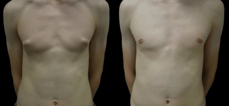 Best Gynecomastia Surgeons in Dubai: Transform Your Look with Expert Care