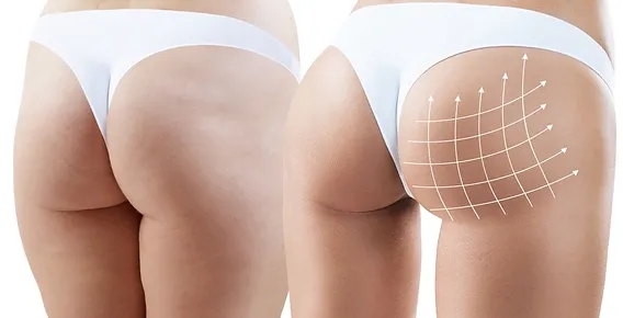 Butt Fat Transfer in Dubai: The Ultimate Guide to Natural Enhancement