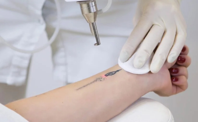 How Much Does Tattoo Removal Cost?